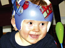Little Alexander Schultz was treated for plagiocephaly at a private clinic 